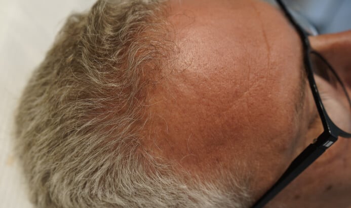 Hairline after tricology