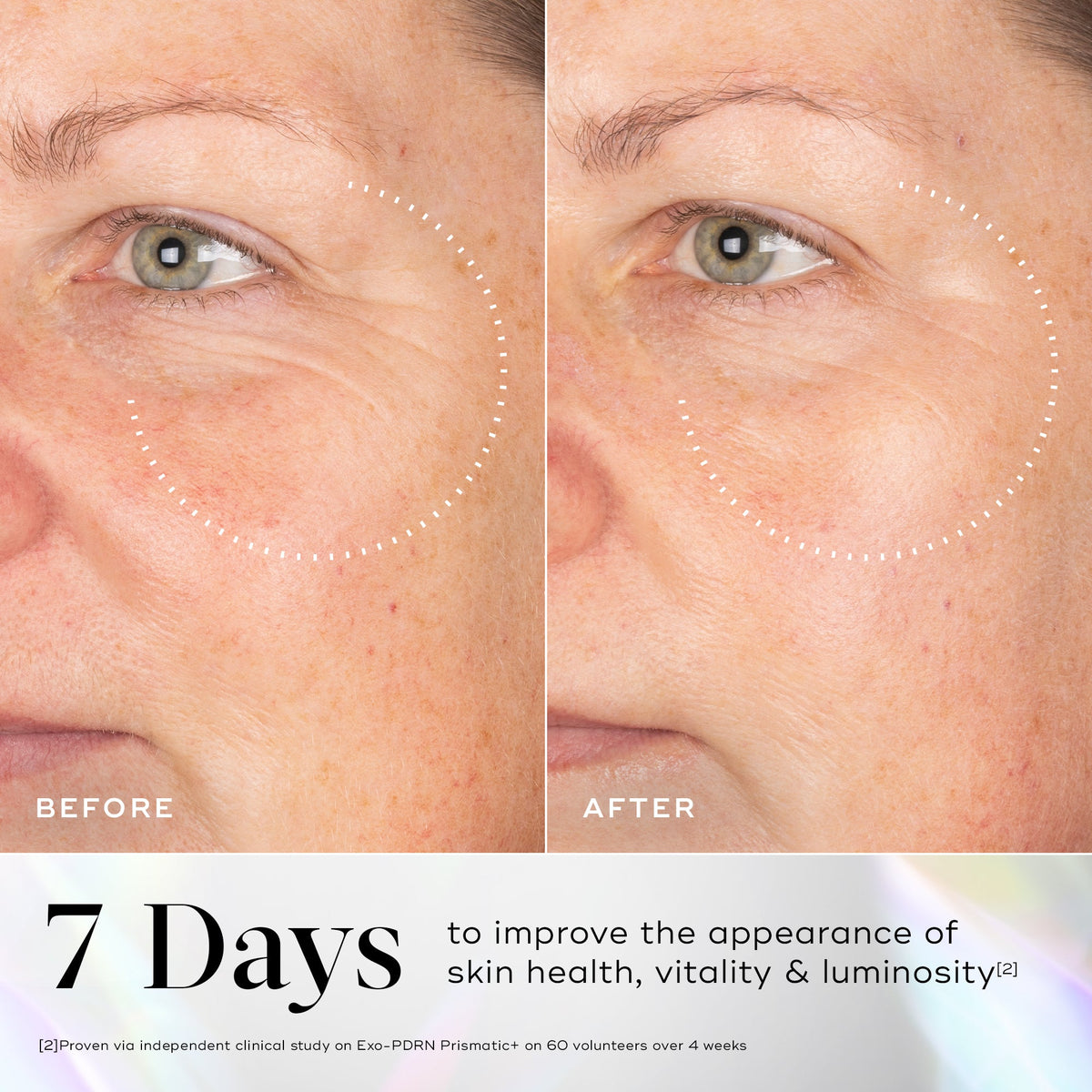 Exo-PDRN Prismatic+ before and after, 7 days