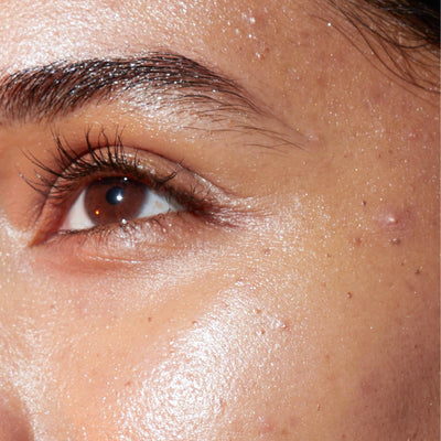 Close-up of skin with blemishes and enlarged pores - skincare for blemishes and pores