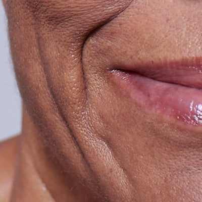 Close-up of smile lines and loss of firmness around the mouth - skincare for firmness