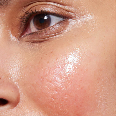 Close-up of redness on the cheek - skincare for redness and sensitive skin